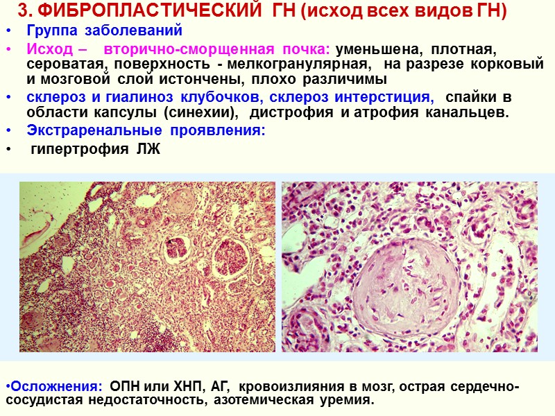 3. ФИБРОПЛАСТИЧЕСКИЙ  ГН (исход всех видов ГН) Группа заболеваний   Исход –